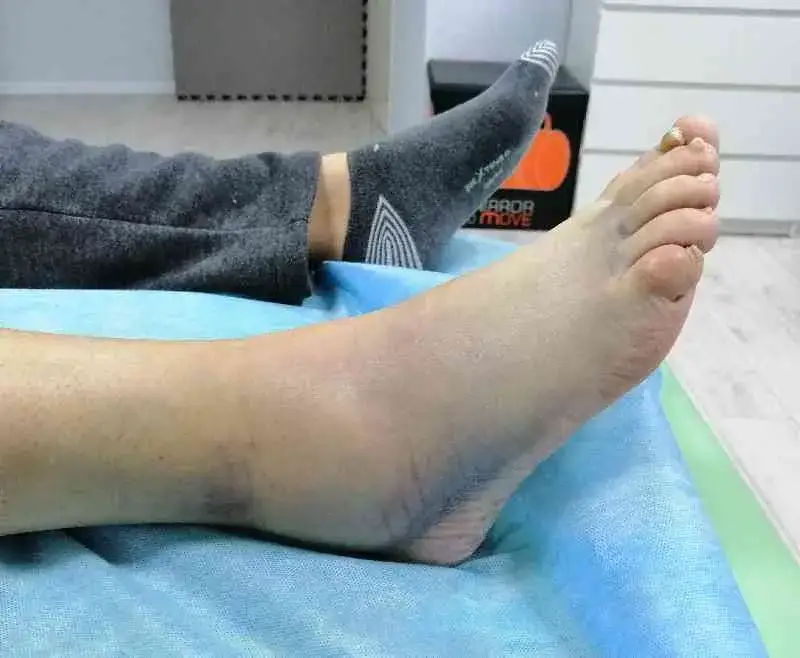 Opuchlizna po skręceniu kostki: ile trwa? Skuteczne rady eksperta