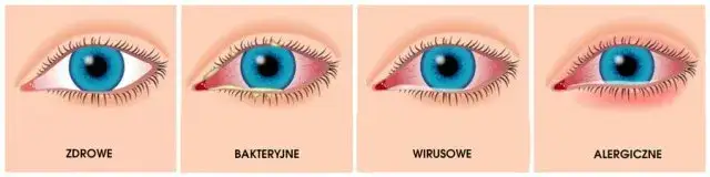 Uczulenie na rzęsy objawy – jak rozpoznać alergię i uniknąć bólu