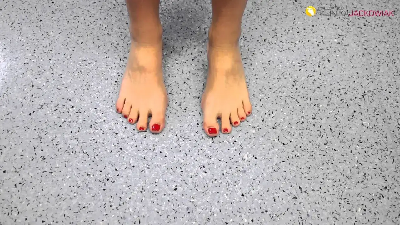 Leczenie haluksów: od ćwiczeń po operację. Co wybrać dla Twoich stóp?