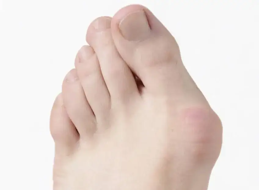 Co na ból haluksów? Ulga, ćwiczenia, leczenie i profilaktyka