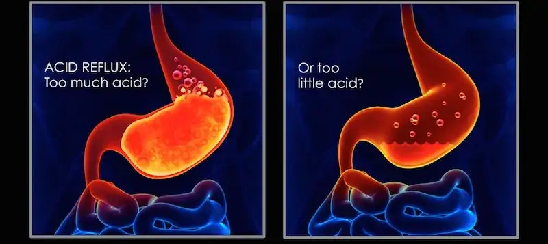 Niedokwaśność żołądka objawy – poznaj, co może ci dolegać