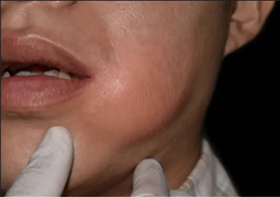 Ropień zęba: Jak szybko złagodzić ból i uniknąć powikłań?