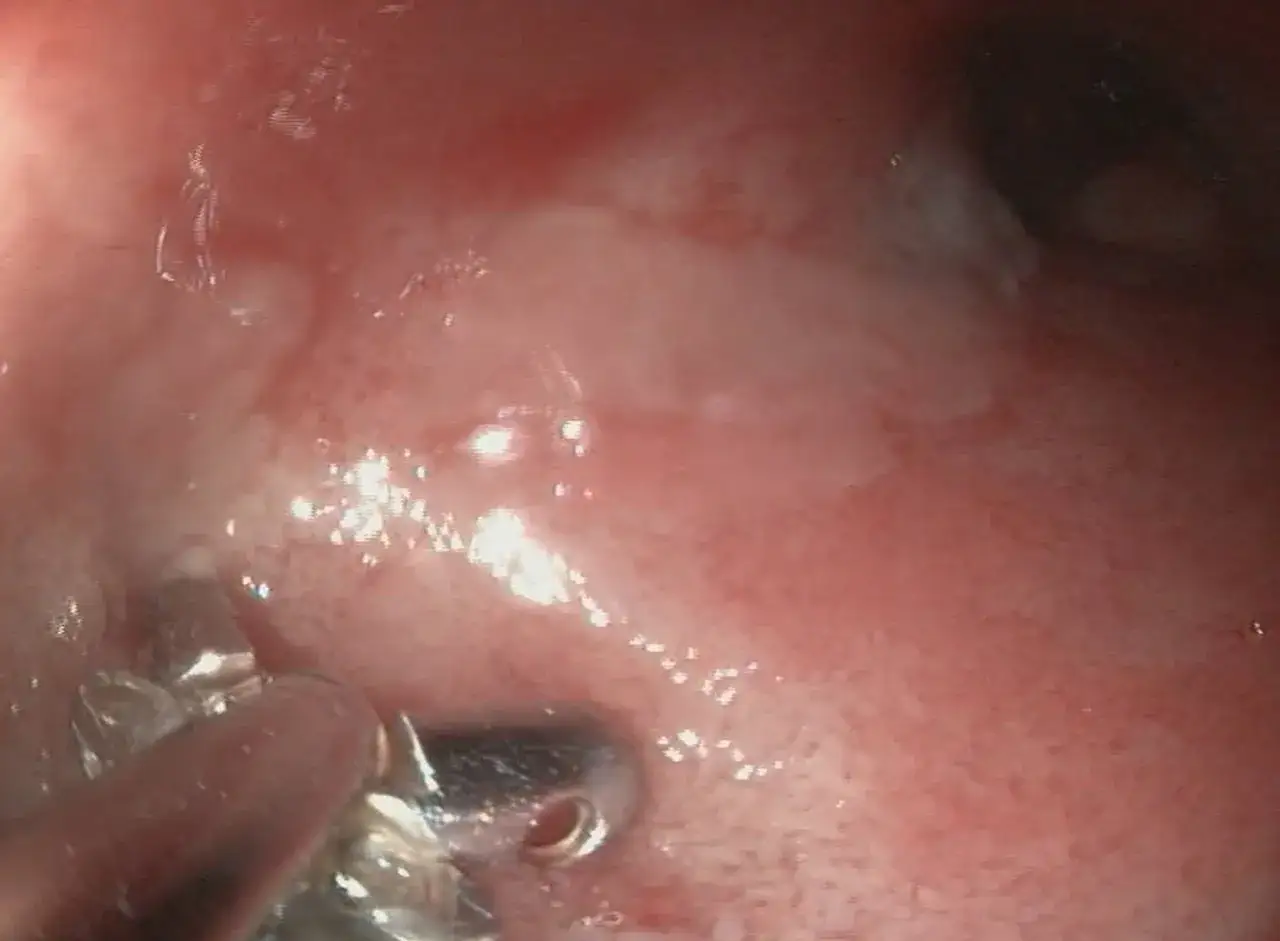 Widok endoskopowy jelita kota z objawami IBD. Widoczne zaczerwienienie i zmiany zapalne.