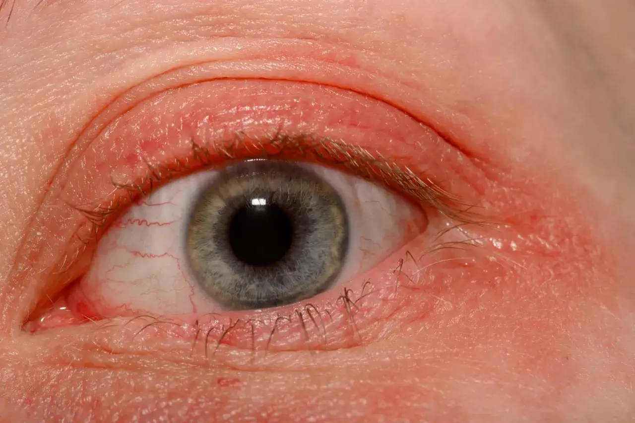 Czy klej do rzęs uczula? Objawy alergii i jak ich unikać