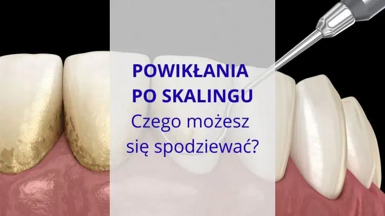Jak bezpiecznie usunąć ząb? Unikaj bólu i powikłań