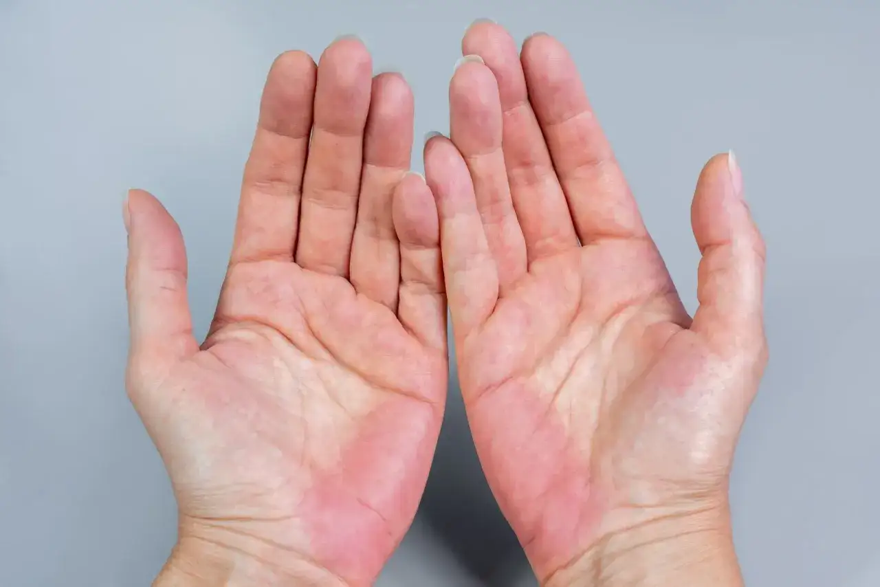 Dłonie z zaczerwienieniem u nasady palców i kciuka. To mogą być chora wątroba objawy.