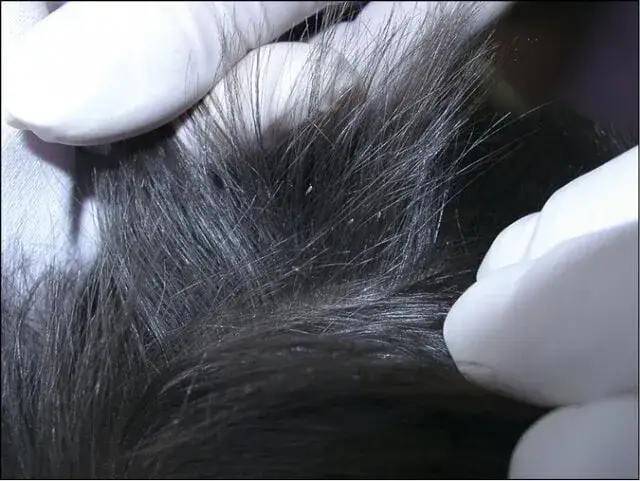 Czym się żywią wszy i jak mogą zagrażać twojemu zdrowiu