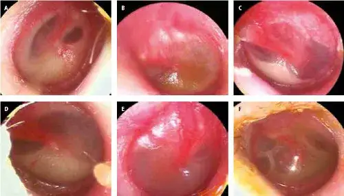 Pęknięcie błony bębenkowej u dziecka objawy, które mogą zaskoczyć rodziców