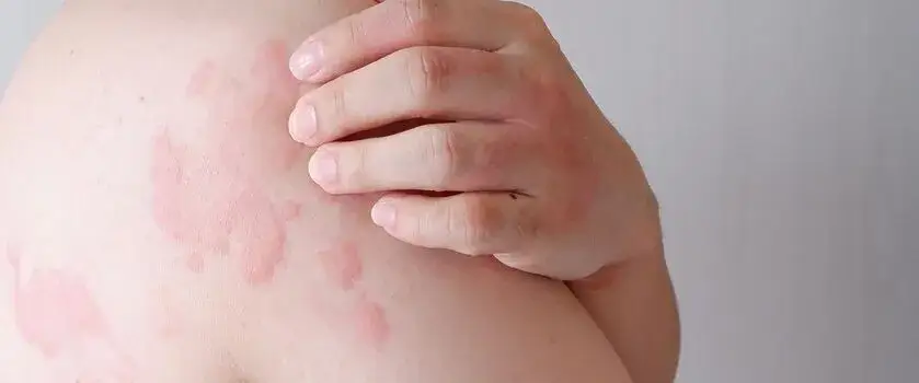 Alergia pokarmowa u dorosłych: objawy skórne, diagnoza, leczenie