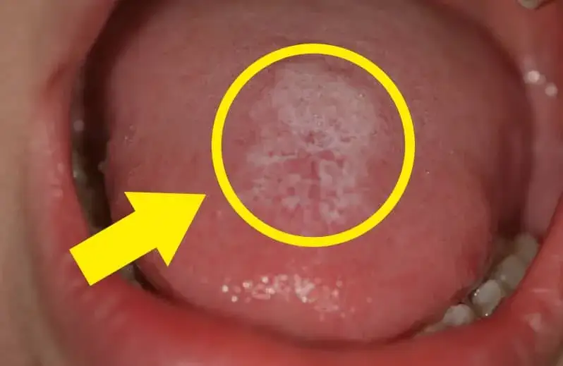 Drożdżyca jamy ustnej objawy – jak rozpoznać i co zrobić?