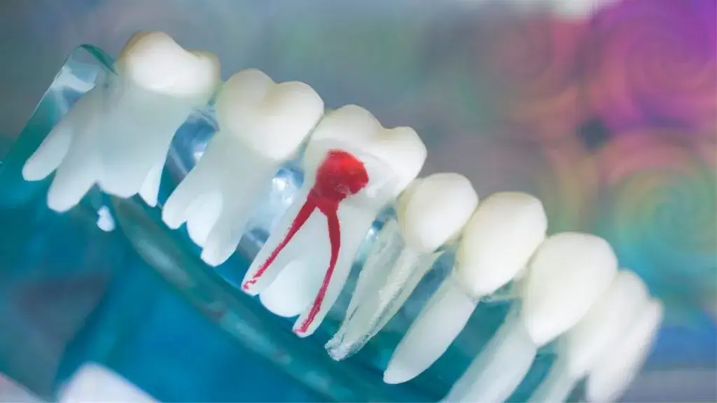 Jak skutecznie uśmierzyć ból zęba po leczeniu kanałowym – sprawdzone metody