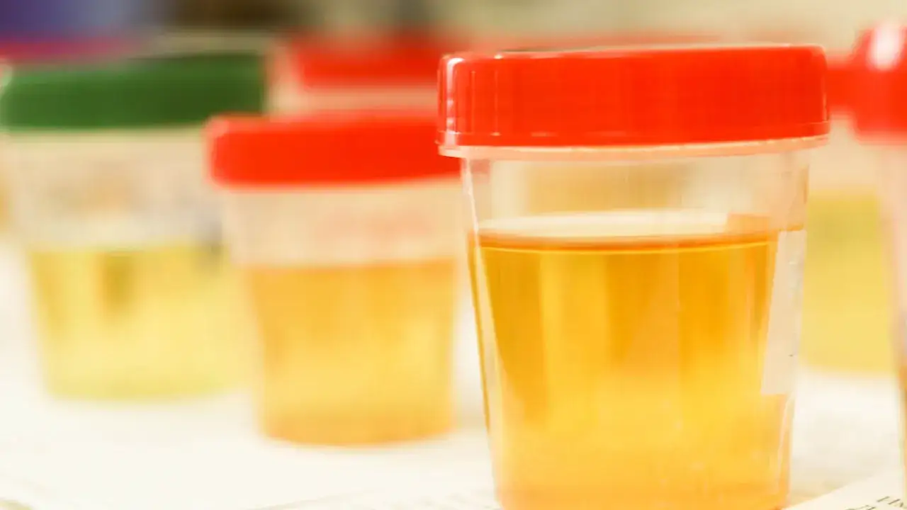 Opis próbki moczu: Co napisać na pojemniku? Uniknij błędów!