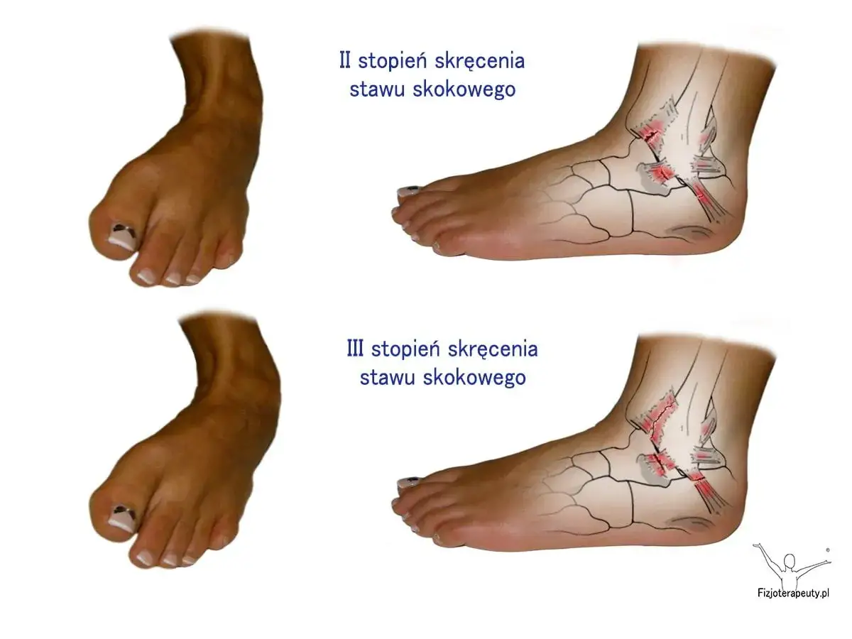 Czy skręcenie kostki boli? Rozszyfruj ból i działaj!