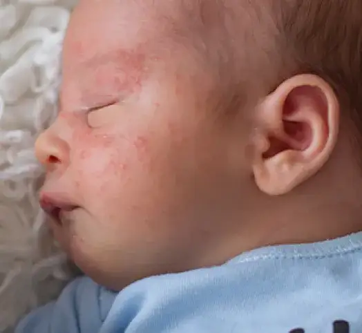 Alergia na BMK u niemowlaka: Objawy, które musisz znać!