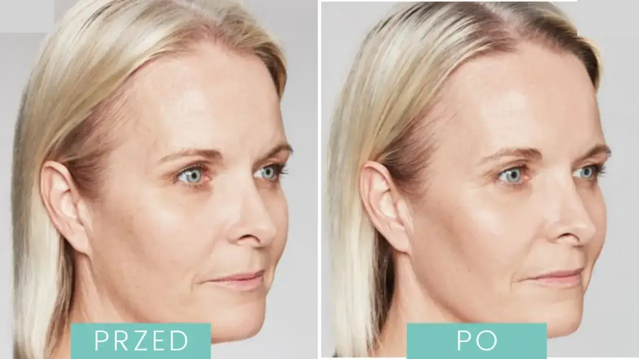 Kwas hialuronowy vs polimlekowy: Co lepsze dla Twojej skóry?