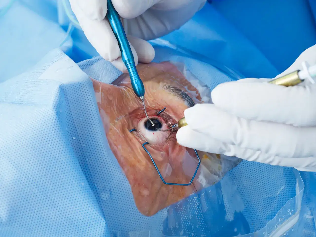 Operacja zaćmy: Na czym polega? Twój przewodnik do nowego wzroku