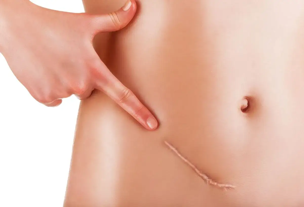 Strup po pryszczu? Skuteczne sposoby na szybkie gojenie bez blizn