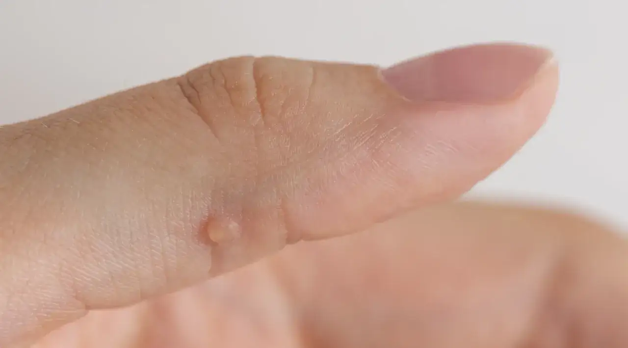 Jakiego lekarza wybrać na kurzajki, aby skutecznie je wyleczyć?