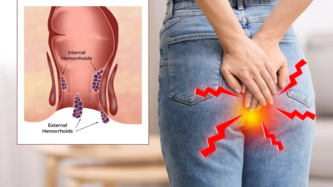 Skuteczne sposoby na hemoroidy po porodzie - ulga i zdrowie
