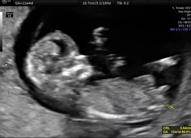 Jak obliczyć długość dziecka z USG – kluczowe pomiary i metody