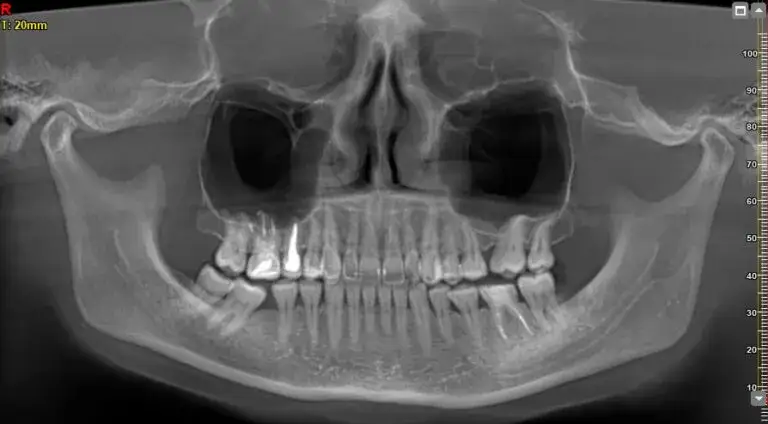 Czy pantomogram jest na NFZ? Sprawdź, co musisz wiedzieć, aby skorzystać