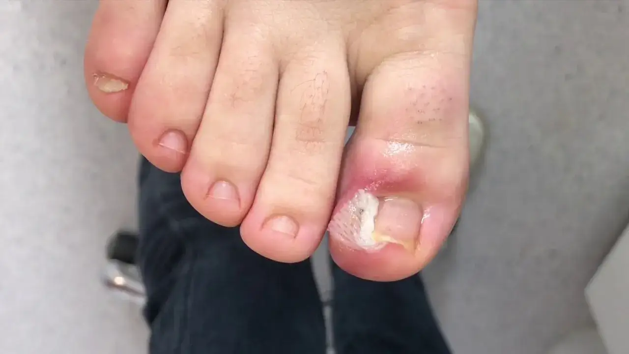 Jak wyciągnąć drzazgę spod paznokcia - skuteczne metody i porady