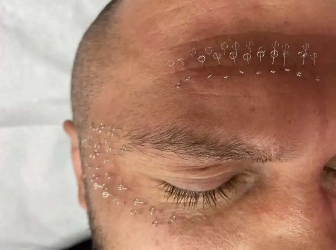 Pinezki do twarzy: naturalny lifting, redukcja zmarszczek. Jak działają?