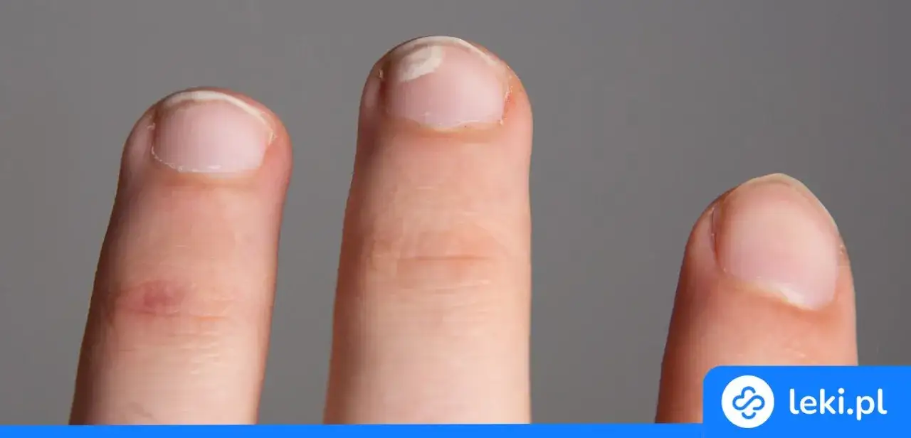 Białe plamki na paznokciach? Dieta z cynkiem i białkiem to klucz!
