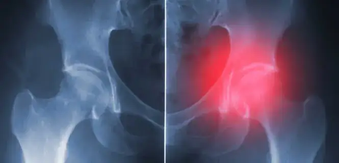 Jakie endoprotezy stawu biodrowego refunduje NFZ i co musisz wiedzieć