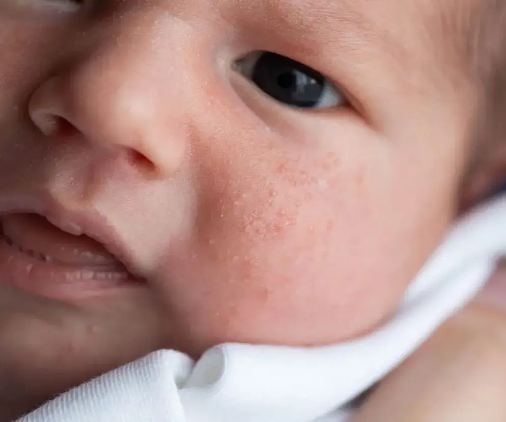Alergia u niemowlaka: jak rozpoznać objawy i pomóc dziecku?
