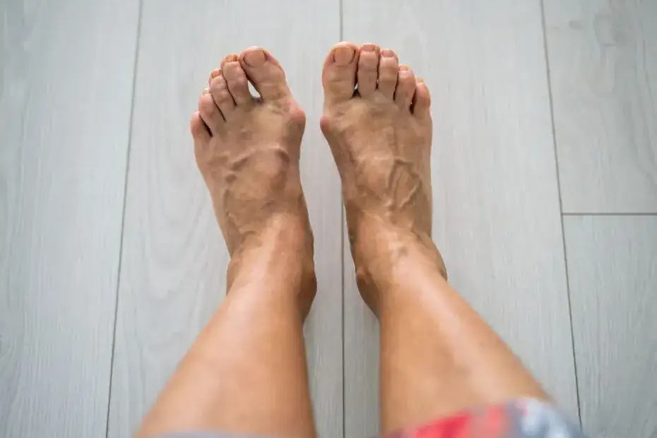 Haluksy: Skuteczne leczenie i ulga w bólu co naprawdę działa?