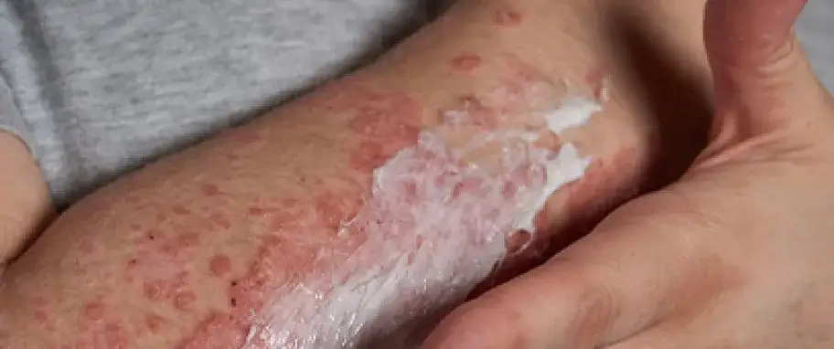 Alergia: Jak rozpoznać, leczyć i żyć bez objawów? Pełny przewodnik