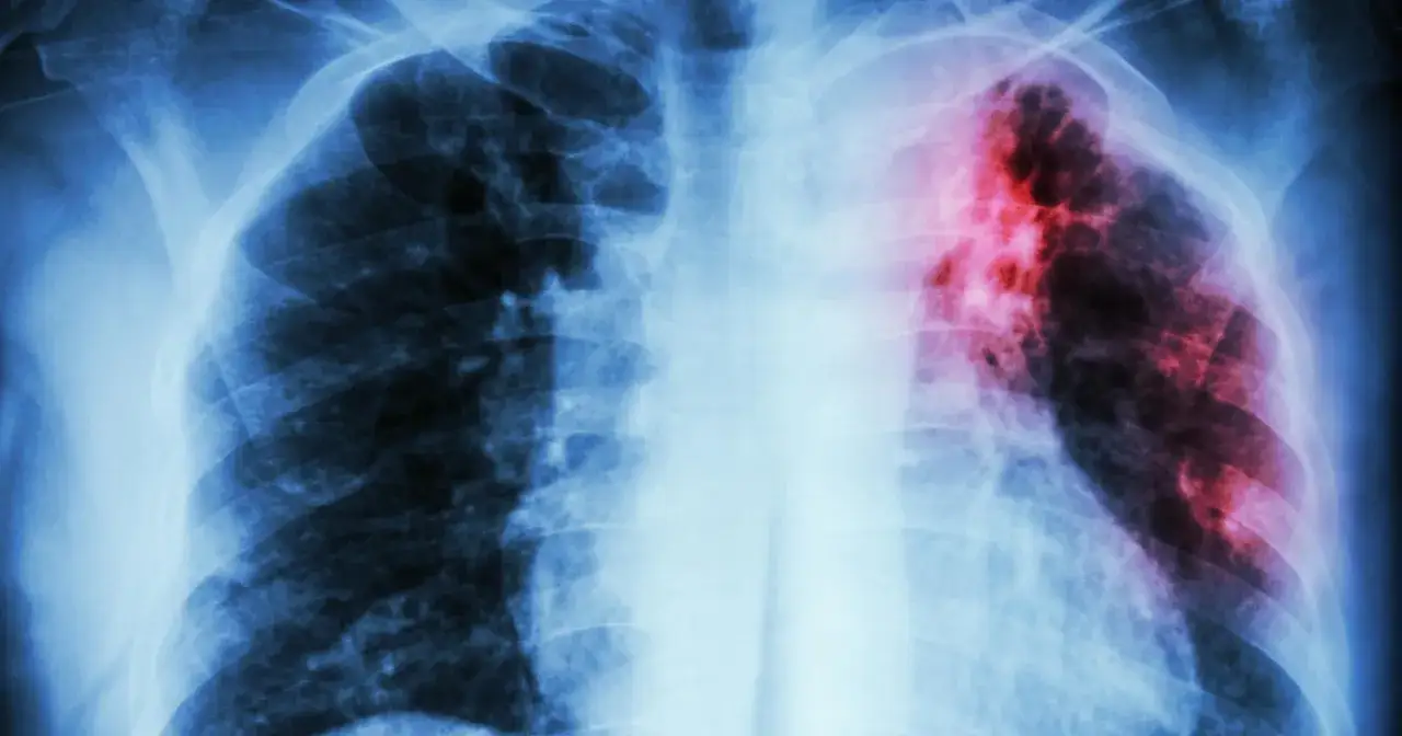 RTG płuc z widocznymi zmianami w prawym płacie, sugerującymi tbc. Ciemne obszary i zaczerwienienie wskazują na chorobę.