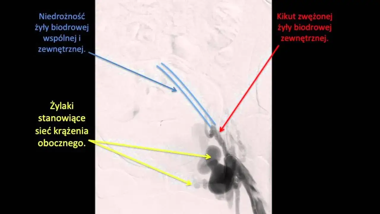 Niedrożność tętnicy biodrowej objawy: jak rozpoznać i leczyć?