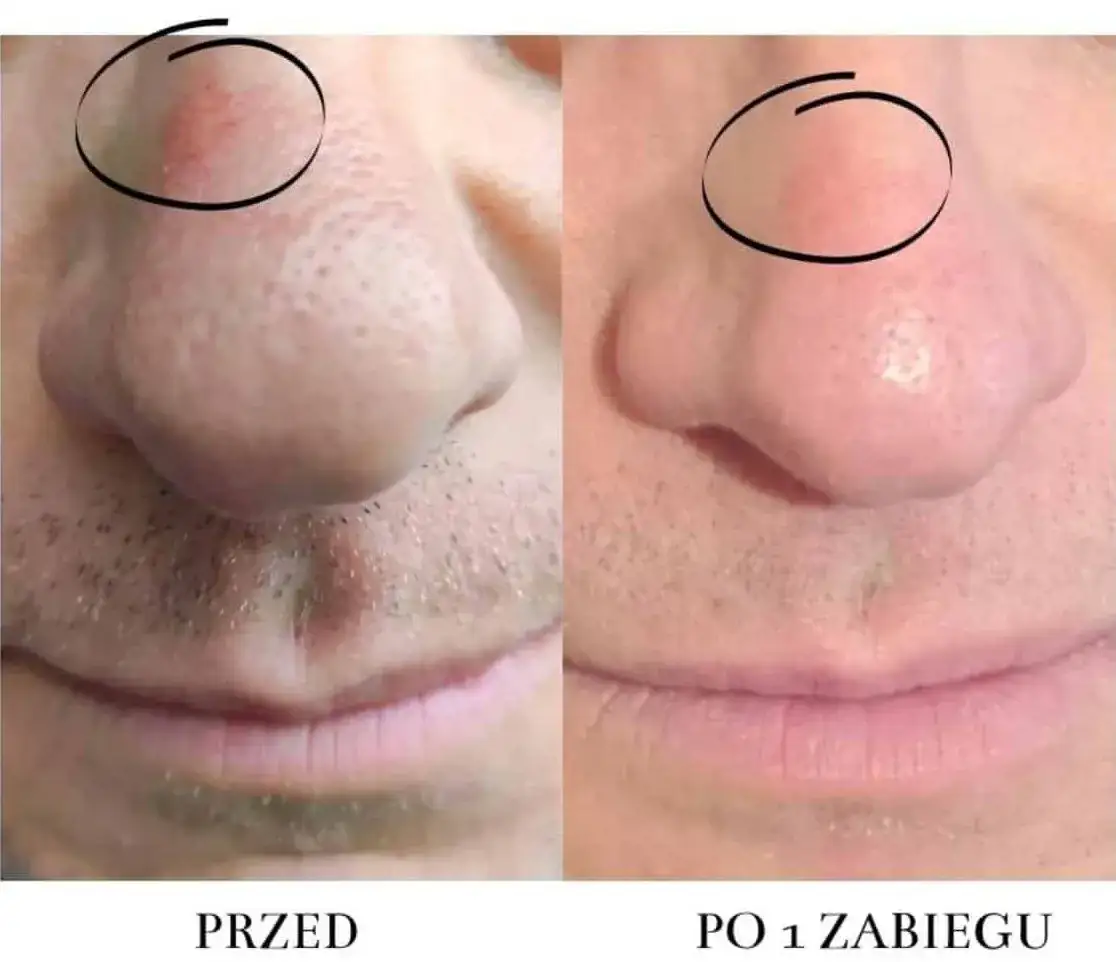 Cera naczynkowa: Jak się pozbyć rumienia i wzmocnić naczynka?