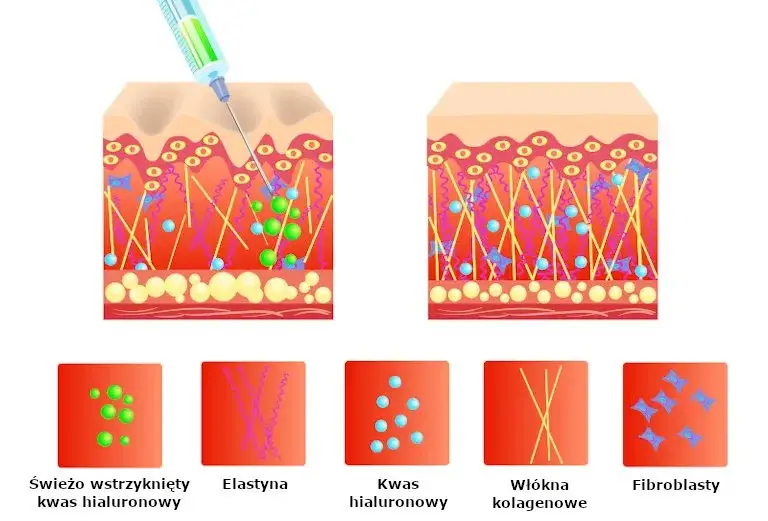 Jak nakładać kwas hialuronowy, aby uniknąć najczęstszych błędów