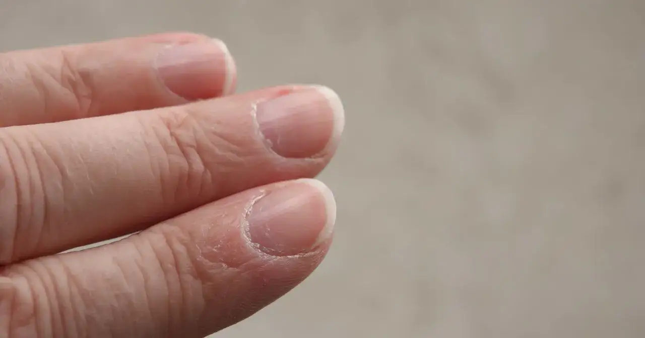 Zbliżenie na palce dłoni z widocznymi pękającymi skórkami przy paznokciach. Skóra jest sucha i łuszcząca się.