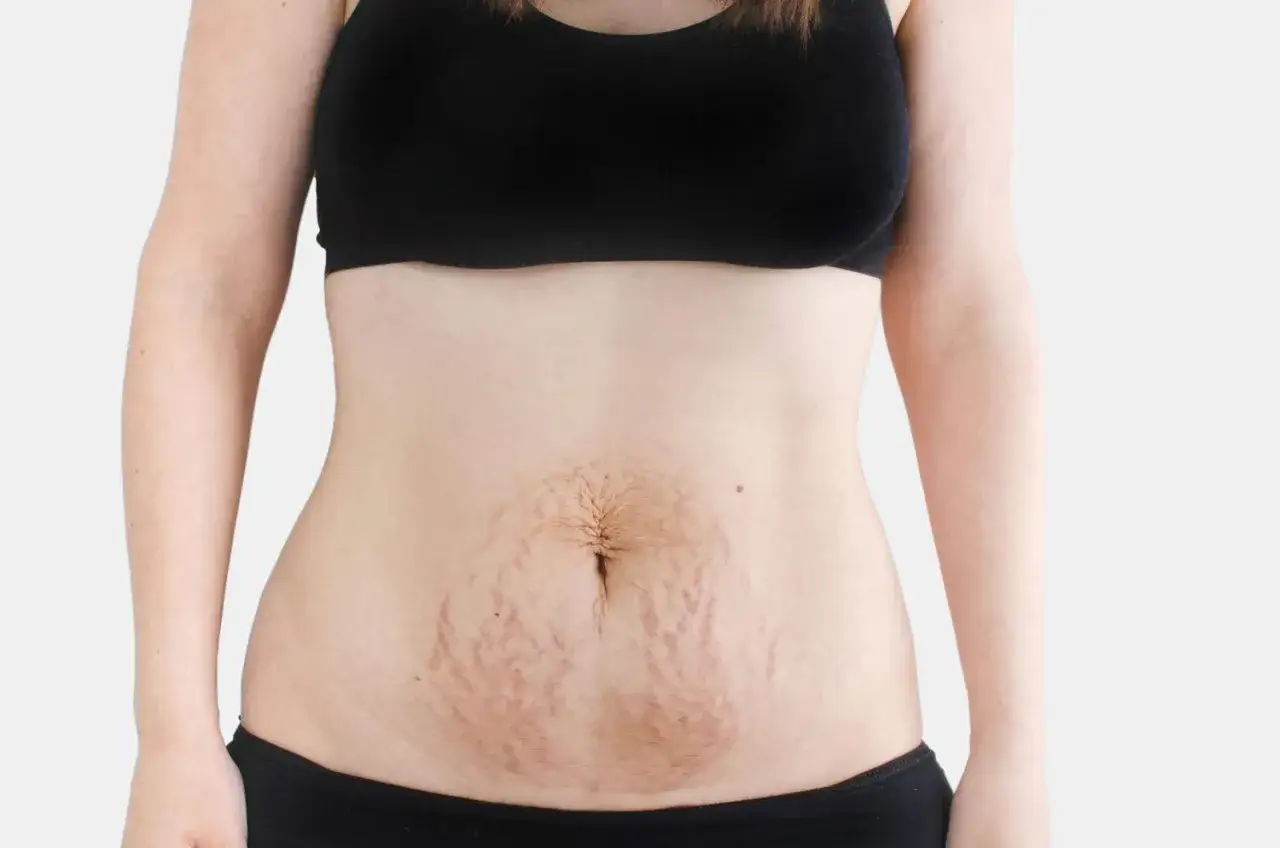 Brzuch miesiąc po porodzie, z widocznymi rozstępami. Ciało po ciąży, naturalne zmiany.