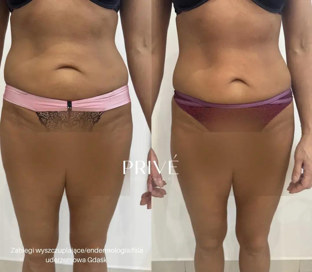 Endermologia: Bezinwazyjne modelowanie sylwetki co musisz wiedzieć?