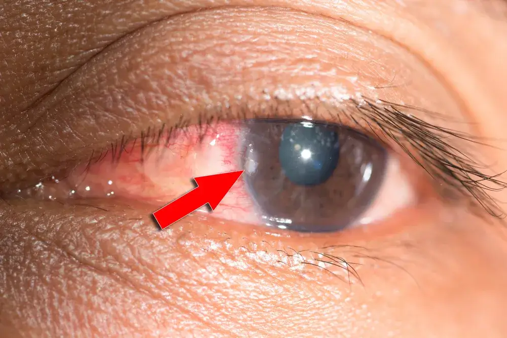 Jak okulista usuwa ciało obce z oka? Procedura krok po kroku