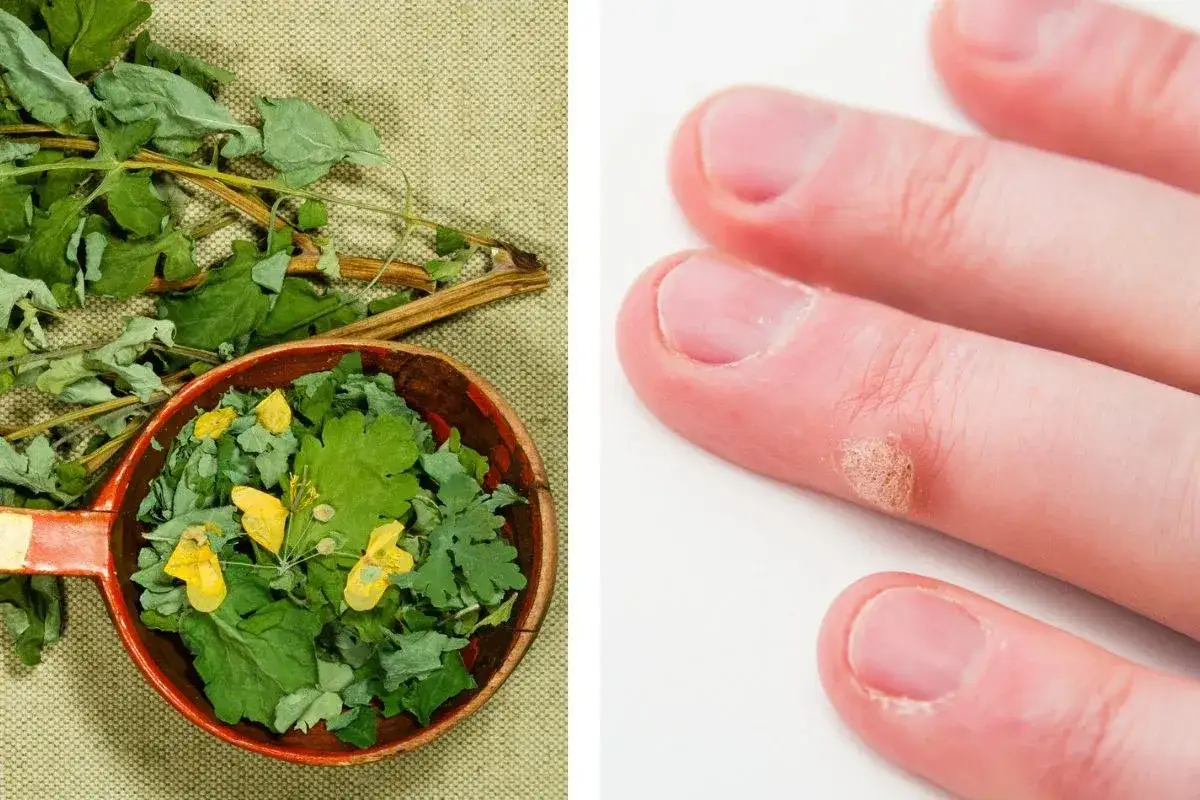 Suszone zioła glistnika w drewnianej misce i kurzajka na palcu. Dowiedz się, jak zrobić maść z glistnika.