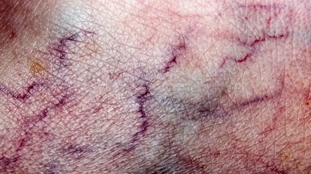 Zakrzepica – jakie badania krwi są kluczowe dla Twojego zdrowia?