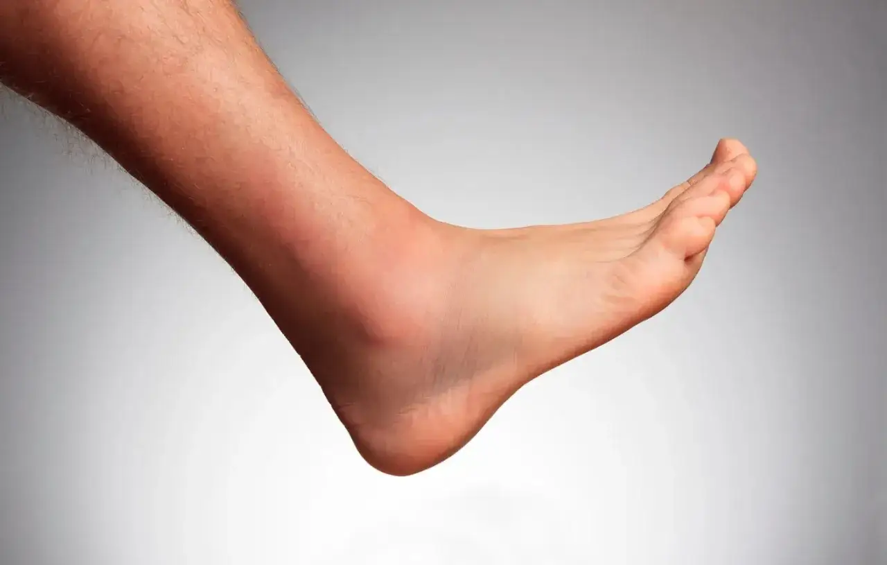 Uraz Lisfranca czy skręcenie śródstopia? Objawy, leczenie, pomoc