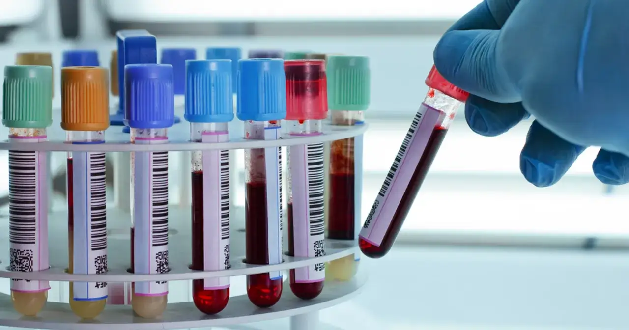 Ręka w niebieskiej rękawiczce trzyma probówkę z krwią. W tle stojak z innymi próbkami. Badanie kreatyniny to klucz do oceny funkcji nerek.
