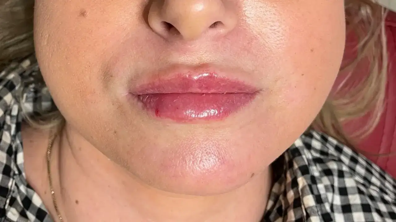 Usta po zabiegu z kwasem hialuronowym. Widoczne zaczerwienienie i nierówności świadczą o tym, że kwas hialuronowy został podany za płytko.