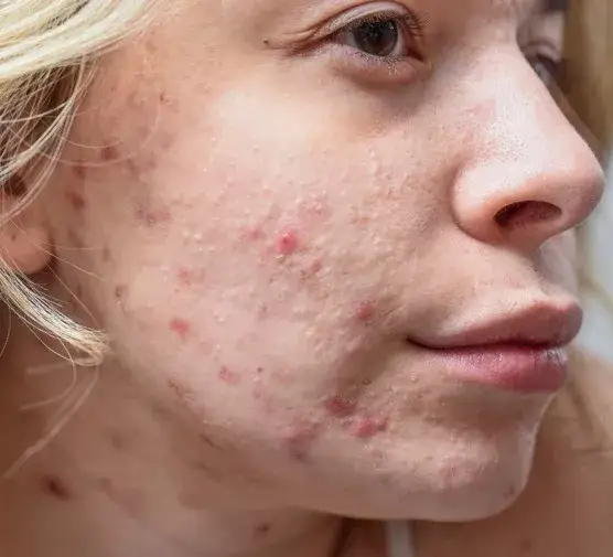 Jak wygląda zapchana cera? 5 oznak, które musisz znać