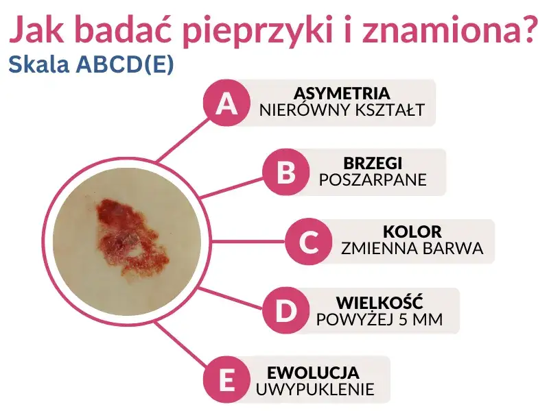 Wczesne objawy czerniaka: Jak rozpoznać i co robić?