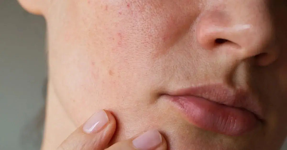 Jak przestać wyciskać pryszcze i poprawić zdrowie swojej skóry