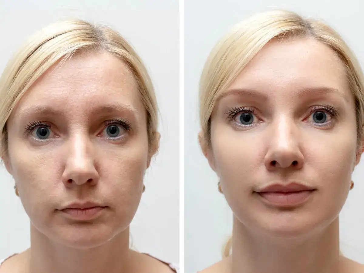 Przed i po: joga twarzy ćwiczenia wygładzają zmarszczki, odmładzając wygląd.