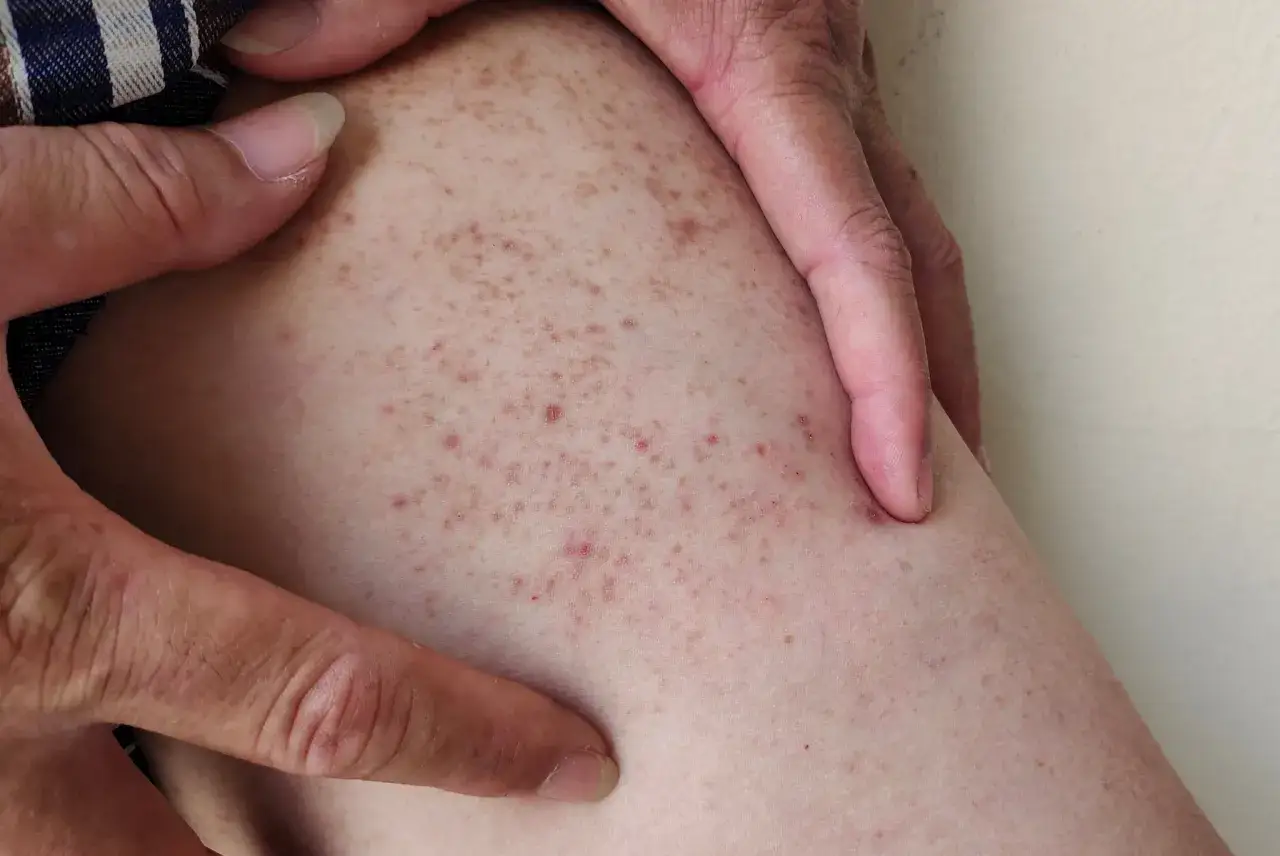 Jak się golić żeby nie było krostek – skuteczne sposoby na gładką skórę